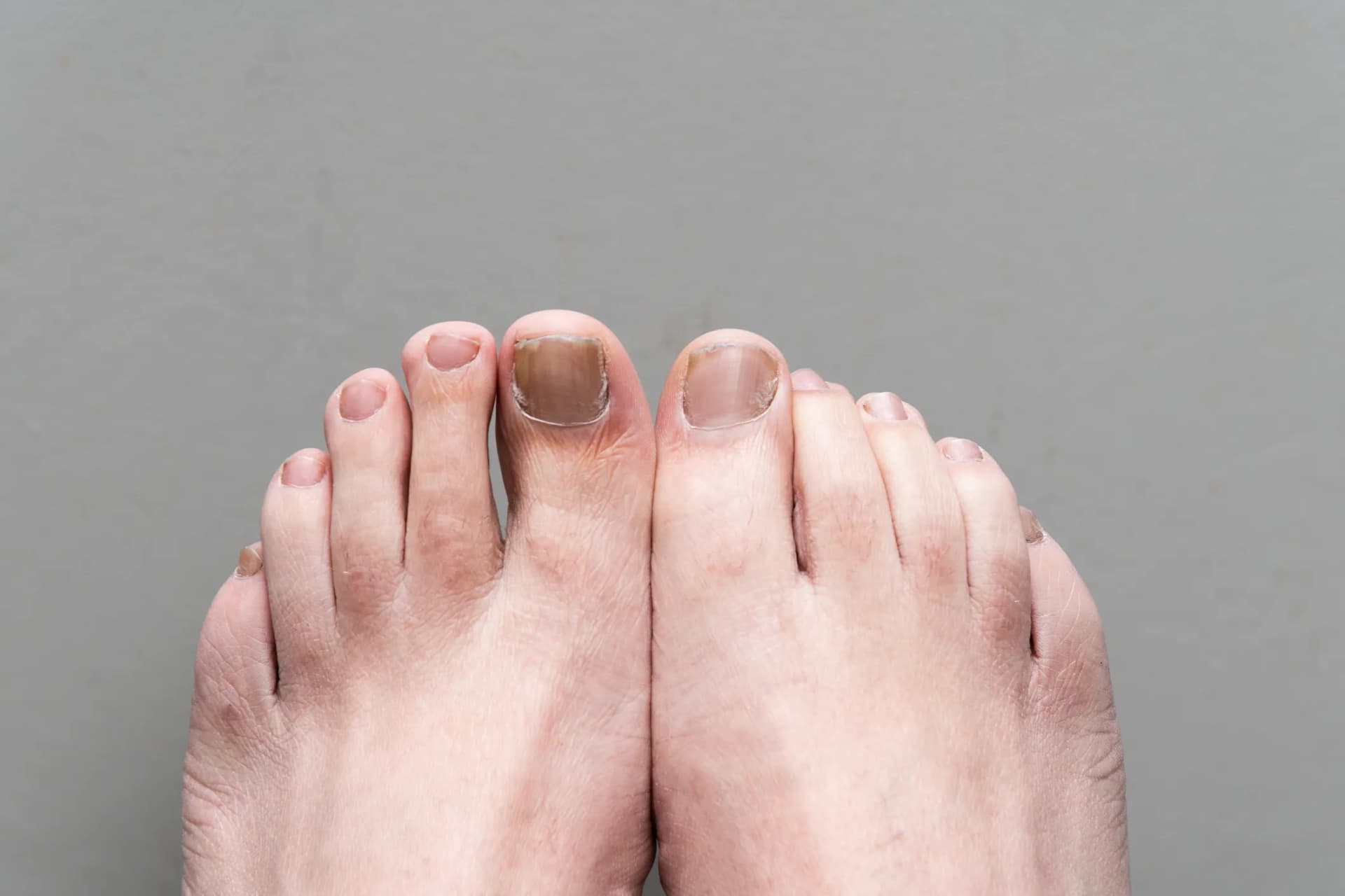 Best Foot Fungus Treatment Options: Prescription vs OTC