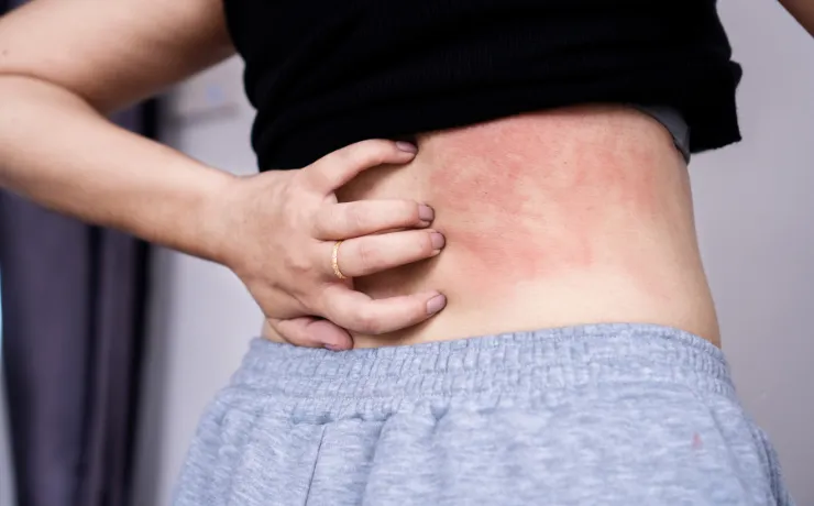 Understanding Shingles – Symptoms, Vaccine, and Relief Options