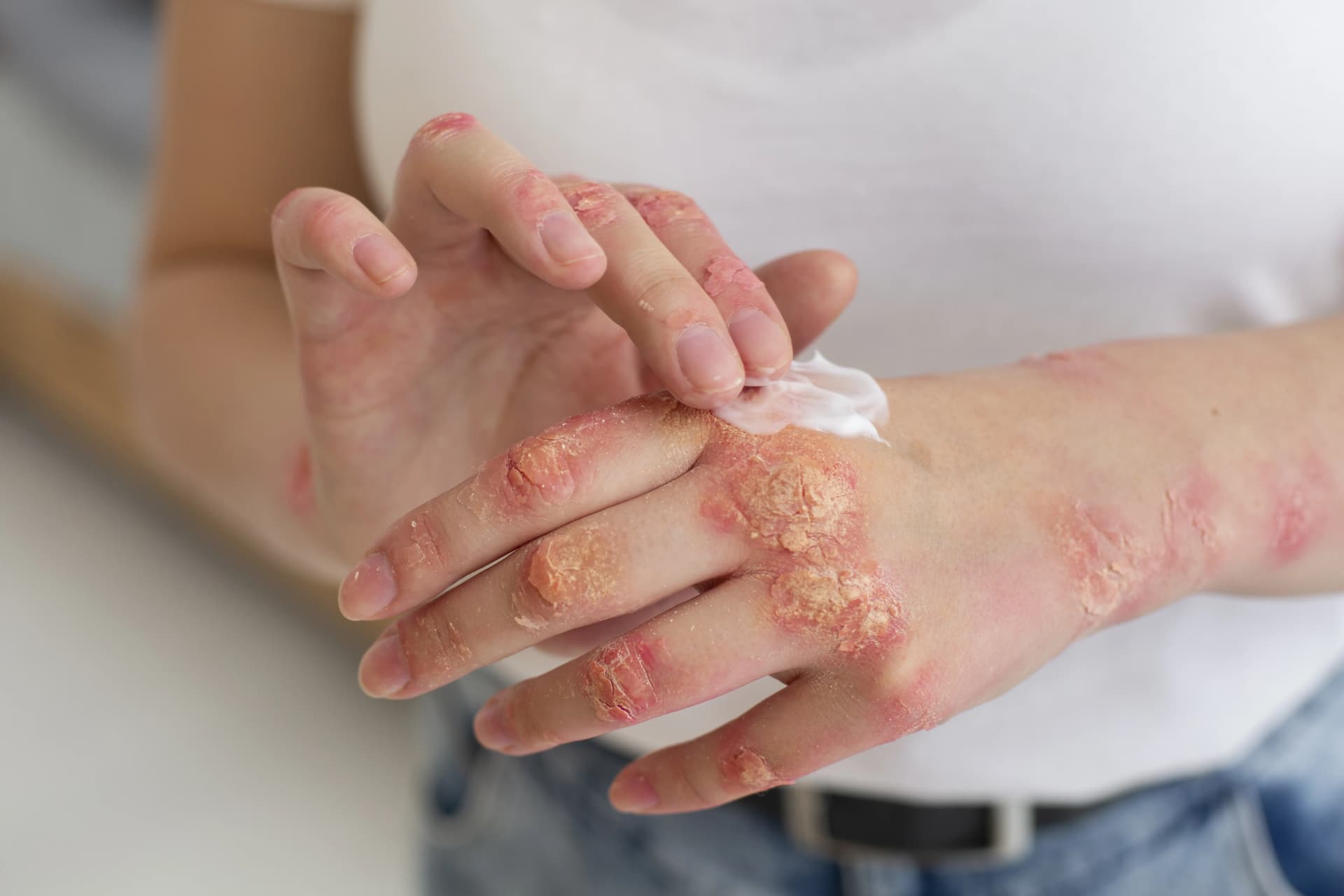 What Is Psoriasis? Understanding the Skin Condition and How to Manage It