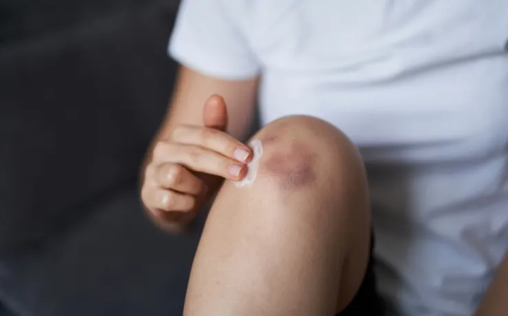 When to Use Topical vs Oral Pain Relievers